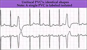 Pvc Premature Ventricular Complex Unifocal Medical Specialties Premature Anesthesia