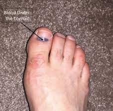 This can cause the blood vessels to break and bleed under the nail. Subungual Hematoma Footeducation