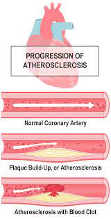 How to know i have a heart disease? 9 Steps For Improving Heart Health Naturally Pritikin Icr