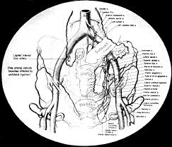 The major branches of the internal iliac artery are the superior gluteal, internal pudendal, obturator, and lateral sacral arteries. Surgical Management Of Intractable Pelvic Hemorrhage Glowm