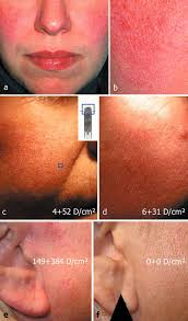 Image result for demodex rosacea