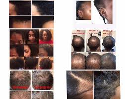 The final stage of the growth cycle is the telogen phase, in which new hair begins to grow underneath the club hair. Midori Family Organic Hair Growth Oil Alopecia Hair Loss With Etsy In 2021 Alopecia Hair Growth Hair Growth Cream Hair Growth Oil
