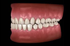 The initial phase of treatment might require the active use of braces for approximately 18 months, followed by orthognathic surgery. What Is An Underbite Orthodontist Mt Pleasant Sc