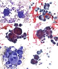 Mesothelioma is a rare type of cancer that that develops in the pleura, a thin membrane that separates the lung from the chest wall. Diseases Of The Pleura Springerlink