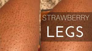 4 Cara Mudah Atasi Kaki Stroberi Bisa Gunakan Lemon Hingga Garam Tribunnews Com Mobile