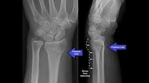 Image result for Wrist XRay