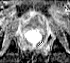 Magnetic resonance imaging in locally advanced rectal cancer: quantitative  evaluation of the complete response to neoadjuvant th