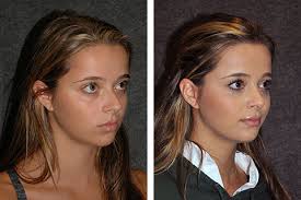 Nose job before and after female. Rhinoplasty New York New York Nose Job Rhinoplasty Nyc
