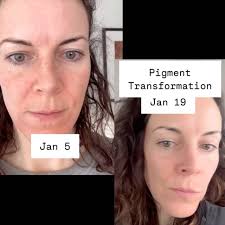 It’s hard to believe these videos were taken only 2 weeks apart. In the  first, I was in the early in the active corrective phase of my pigment  clearing case study. My skin was looking rough, dry and ...