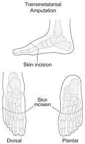 Image result for toe amputation