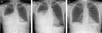 The pleura are thin membranes that line the lungs and the. Pleural Effusion Causes Types Symptoms Diagnosis And Treatment