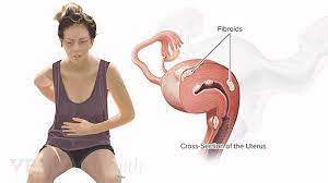 Uterine tubes, oviducts, fallopian tubes. Lower Right Back Pain From Internal Organs