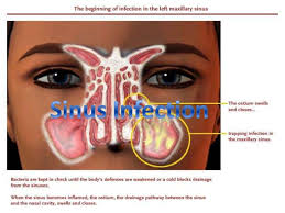 Do nasal sprays treat sinus infection? Natural Remedies For Sinus Problems