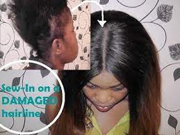 Sew In On Damaged Hairline How I Do It Loose Waves Hair Hairline Loose Hairstyles