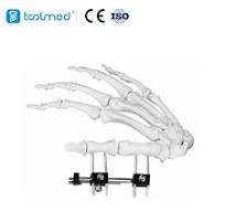 Mini Fragment External Fixator (Finger and Palm) 5100-0103 ...