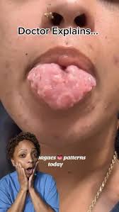 Image result for Fissured tongue
