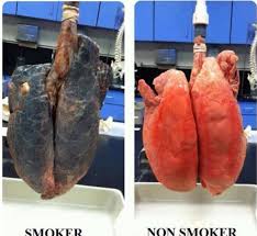 Punca paru paru bocor @ pneumothorax. Hidap Barah Paru Paru Tahap 4 Akibat Merokok Walaupun Berkali Dinasihati Doktor Iluminasi