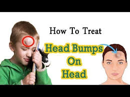 How To Treat Swelling On The Head From An Injury Home Remedies For Head Bump Goose Egg Bruises Remedy Forehead Bumps Home Remedies For Bruises