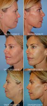 Neck Lift Surgery Before After Neck Lift Neck Liposuction Neck Lift Surgery