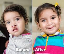 Operation Smile
