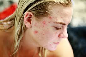 Acne rosacea may affect your eyes, due to this you feel irritated and seem red or watery. Best Dermatologist In Nj For Acne Kessel Dermatology