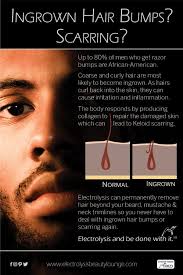 Electrolysis hair removal by beth. Reduce Ingrown Hair Bumps Brown Skin Tone Ingrown Hair Bump Ingrown Hair