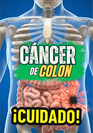 El cáncer de colon es una de las principales causas de muerte por cáncer en  el mundo, pero cuando se detecta a tiempo, tiene altas probabilidades de  tratamiento exitoso. En este video explicamos ...