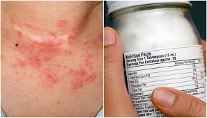 How Coconut Oil Works Wonders For Healing Eczema