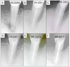 Cemental tears produced symptomatic, localized chronic inflammation characterized usually by a vertical radiolucency adjacent to a root. Regenerative Treatment Of A Cemental Tear Using Enamel Matrix Derivatives A Ten Year Follow Up