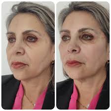 ✨ ¡Rejuvenece tu rostro sin cirugía! Con el lifting facial no quirúrgico  del Dr. Gustavo Ulloa en Clínica Sonríe Arica, puedes recuperar la firmeza  y frescura de tu piel de manera natural