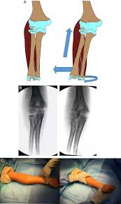 Image result for Lateral Condyle Fracture