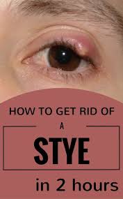 See full list on mayoclinic.org Anyone Confronted With A Stye At Least Once In His Life It S A Painful And Not A Very Pleasant Sensati Eye Stye Remedies Stye Treatment Getting Rid Of A Stye