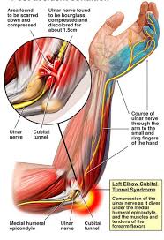 Help I Have A Nerve Entrapment Musicians Health Collective Nerve Entrapment Ulnar Nerve Cubital Tunnel Syndrome