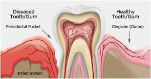 However in a deep teeth cleaning, they continue to remove tartar buildup down below the gum line to the. Teeth Cleaning Cost In Delhi Teeth Polishing Cost