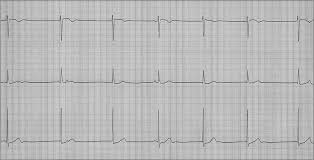Image result for Calcium Channel Blocker Overdose