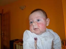 Régime allergie au lait pour les personnes avec intolérance au lait (adultes et enfants). Allergie Aux Proteines De Lait De Vache Docteur Lahlou Najib Les Allergies Au Maroc ÙÙŠØ³Ø¨ÙˆÙƒ