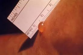 Chiggers inject digestive enzymes into the skin and feed upon the decomposed tissue. Preventing Chigger Bites Chigger Prevention Howstuffworks