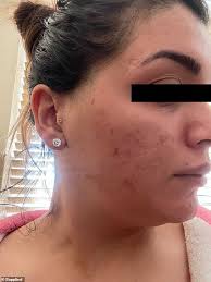 Vitamin a should be an integral part of every person's diet. Jshealth How Mom Transformed Her Skin In Just Eight Weeks