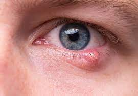 Many of these symptoms are common to other eye conditions, and if you have them it may not necessarily mean you have cancer of the eye. Styes How To Treat Them How To Avoid Them Health Essentials From Cleveland Clinic