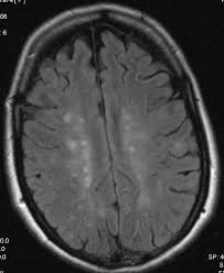 Typische symptome sind ein kribblen im kopf und taubheitsgefühle. Autoimmun Und Mehr Aus Neuroradiologischer Perspektive G Schuierer Zentrum Neuroradiologie Regensburg Pdf Kostenfreier Download