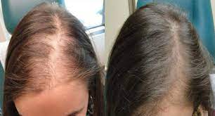 Hair loss occurs in approximately 35 million men and 21 million women. Platelet Rich Plasma Hair Rejuvenation Desa Consulting