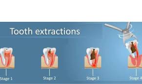 Image result for Tooth Extraction
