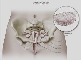 Ovarian cancer is the most common cause of cancer death from gynecologic tumors in the united states. Ovarian Cancer Facts Types Symptoms Osuccc James