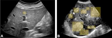 We did not find results for: Diagnosis Of Focal Liver Lesions From Ultrasound Using Deep Learning Sciencedirect