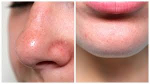 Abidjan has been locked down since march 23. Review My Scheming Blackhead Removal Mask Adventures With Luda