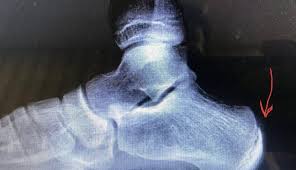 Image result for Calcaneal Apophysitis