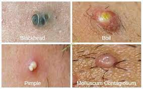 Pimples a pimple is a pore pouch that has been obstructed by a. Ingrown Hair On Vagina Vulva Or Labia Pictures Causes Treatment Home Remedies
