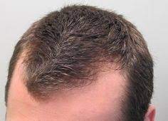 They found that just by using the shampoo enriched with coq10, genes involved in hair growth were increased. 10 Hair Growth Ideas Grow Hair Hair Growth Hair Loss Remedies