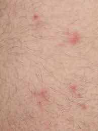 The best solution is to get rid of fleas on pets and in your home. Bed Bug Vs Flea Bites Differences How To Treat And Removing Smithereen