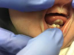 Dientes Natales